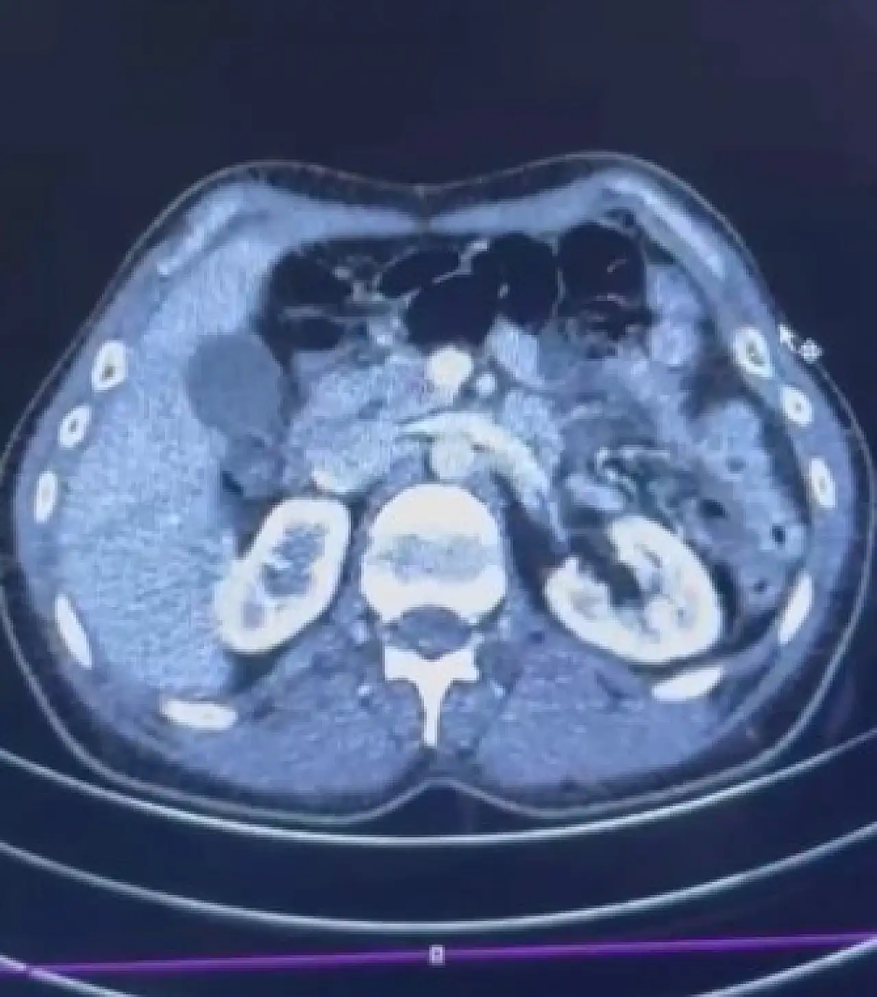 Kayseri'de uluslararası uyuşturucu kurye operasyonu: Midelerinde yarım kilo uyuşturucu çıktı!