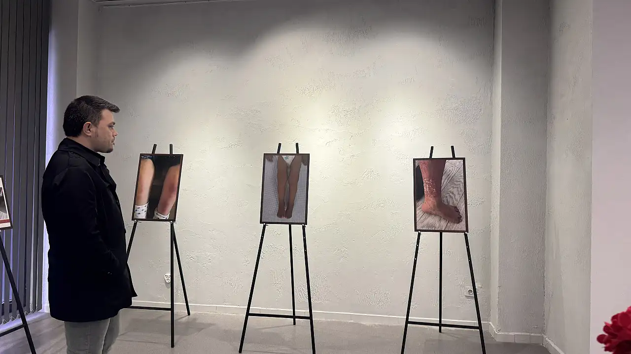 ERÜ'den yapay zeka destekli romatizma sergisi