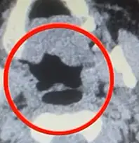 Kayseri'de kadın kuryenin midesinden onlarca adet kapsül uyuşturucu çıktı