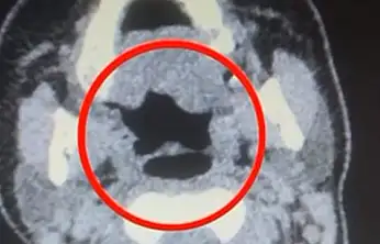 Kayseri'de kadın kuryenin midesinden onlarca adet kapsül uyuşturucu çıktı