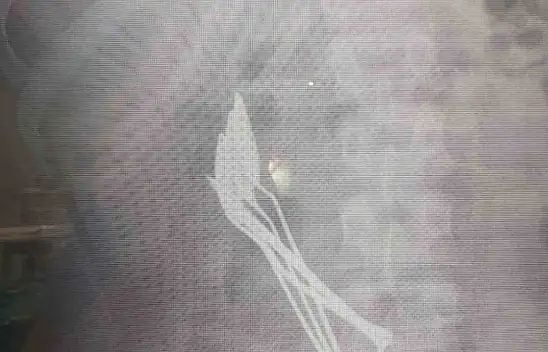 Kayseri'de şaşırtan olay: Çocuğun midesinden bakın neler çıktı