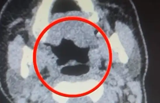 Kayseri'de kadın kuryenin midesinden onlarca adet kapsül uyuşturucu çıktı