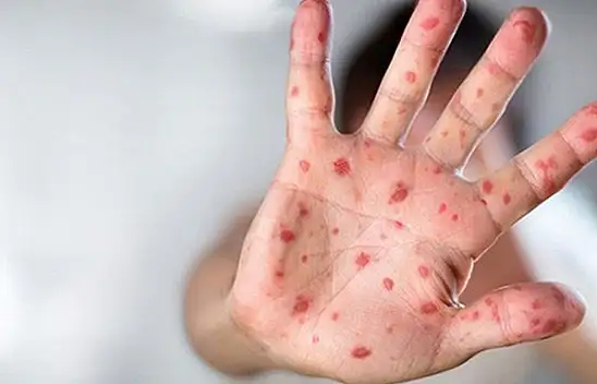 Kayserilileri de tedirgin eden 'maymun çiçeği' hastalığı ile ilgili yeni gelişme!