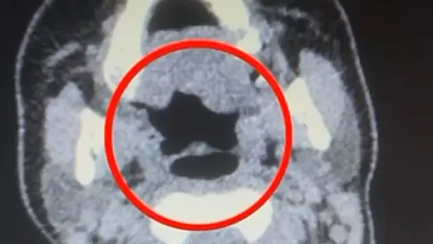 Kayseri'de kadın kuryenin midesinden onlarca adet kapsül uyuşturucu çıktı