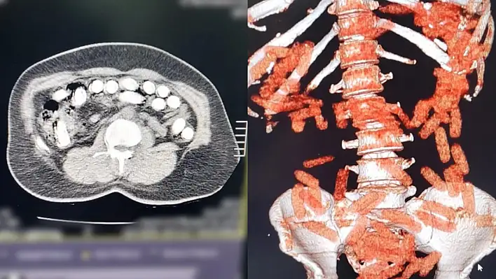 Kayseri'de şaşırtan operasyon! Midesinden neler çıktı neler...