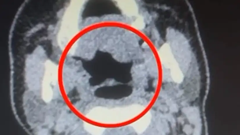 Kayseri'de kadın kuryenin midesinden onlarca adet kapsül uyuşturucu çıktı