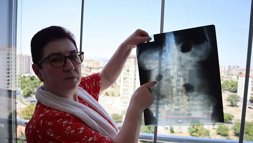 Kayserili Tanyıldız, 22 yıldır karnında iğneyle yaşıyor