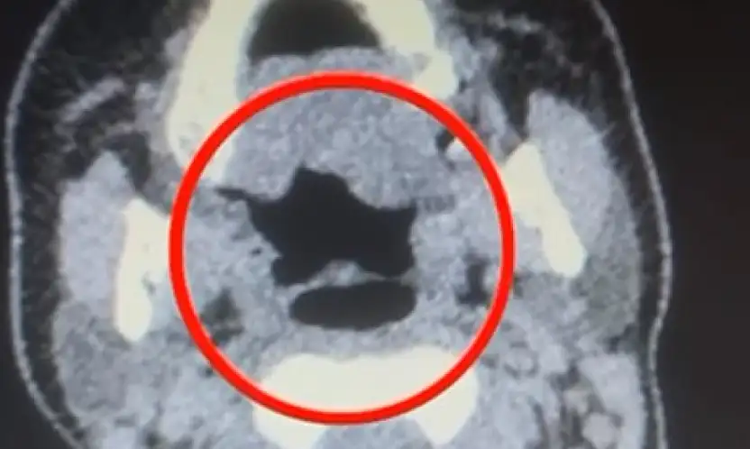 Kayseri'de kadın kuryenin midesinden onlarca adet kapsül uyuşturucu çıktı