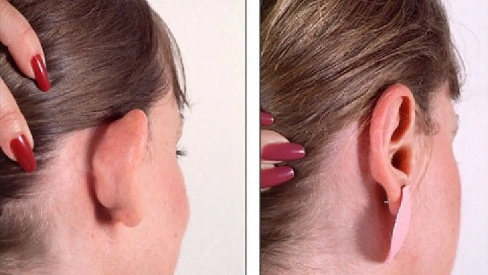 Çocuklarda Kepçe Kulak Nasıl Anlaşılır? Kepçe Kulak Ameliyatı